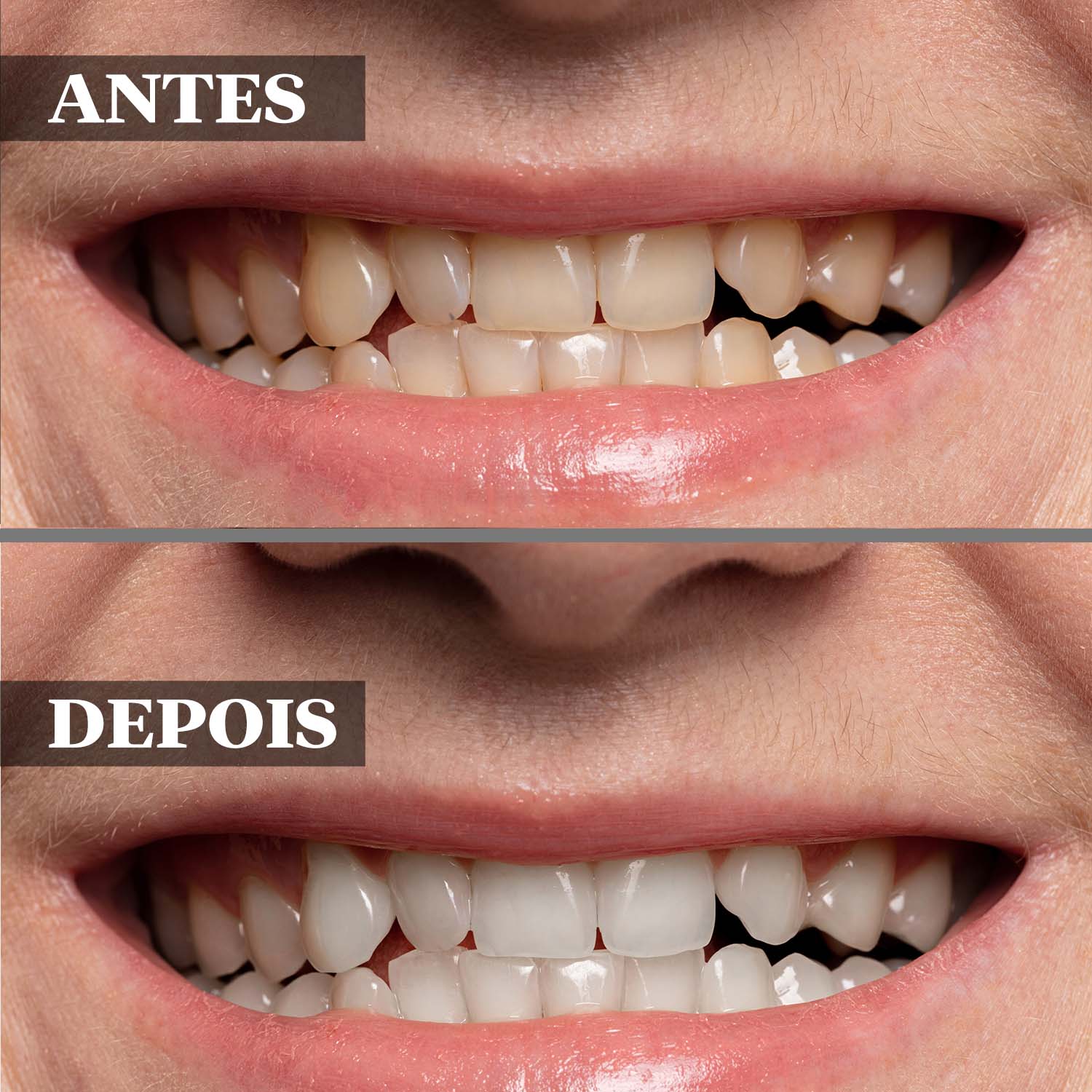 antes e depois de branqueamento dentário