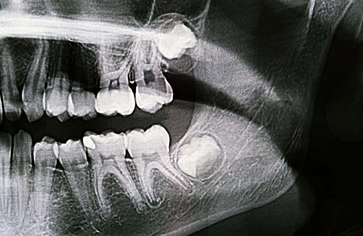 radiografia panorâmica da mandíbula radiografia dos dentes do siso