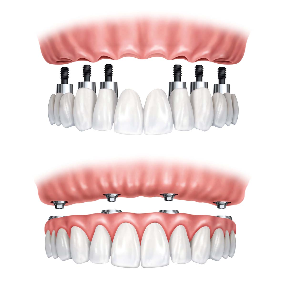 implantes dentários quem são os candidatos ideais